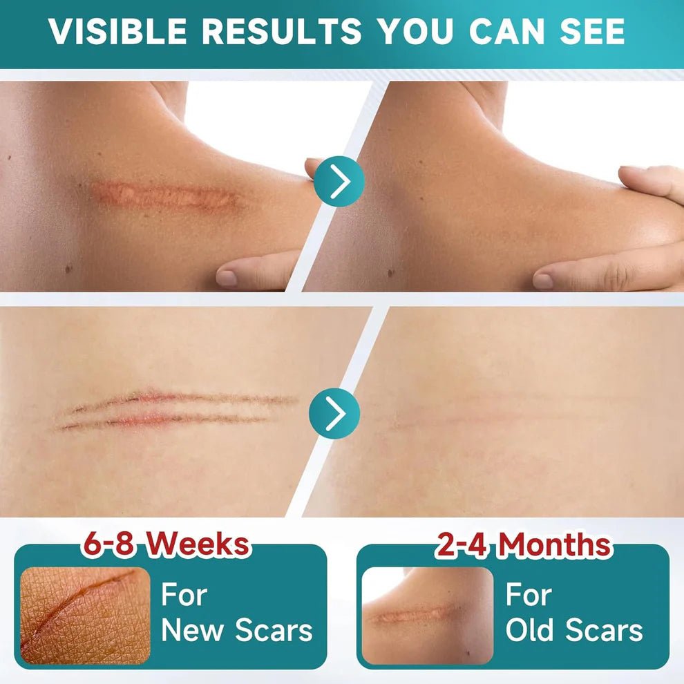 Silicone Scar Tape | Medical Grade Quality