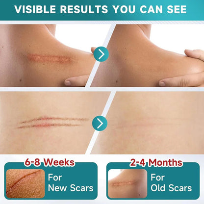 Silicone Scar Tape | Medical Grade Quality